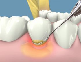 Enfermedades de las encías o Enfermedad periodontal